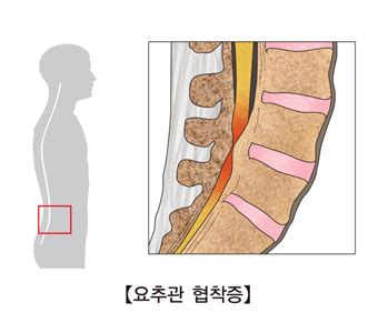 요추부 척추관 협착증의 해부학적 특성 - foraminal stenosis 뜻